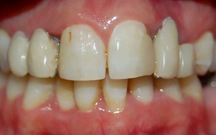 Zbliżenie na zęby, widoczne ubytki i aparat ortodontyczny.