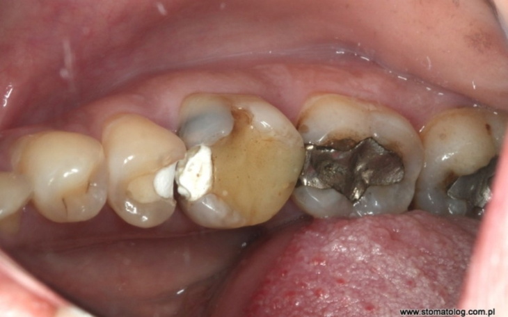 Zbiórka Leczenie kanałowe siódemki - zdjęcie główne