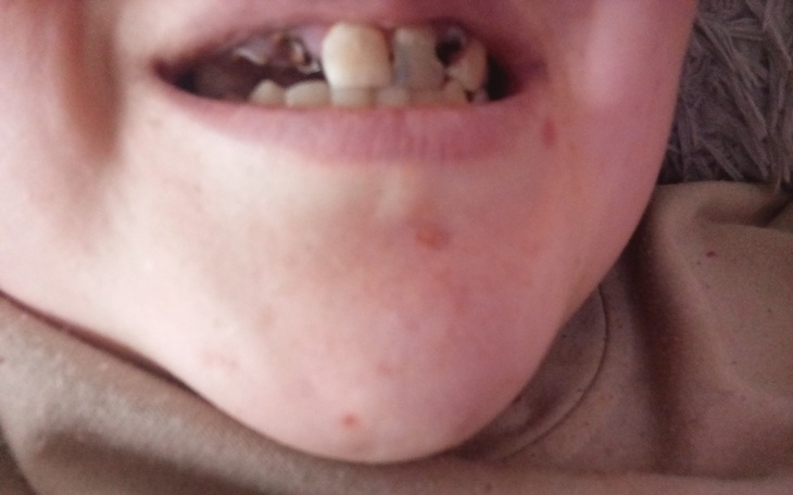 Zbiórka Pomóżmy naprawić moje zęby - zdjęcie główne