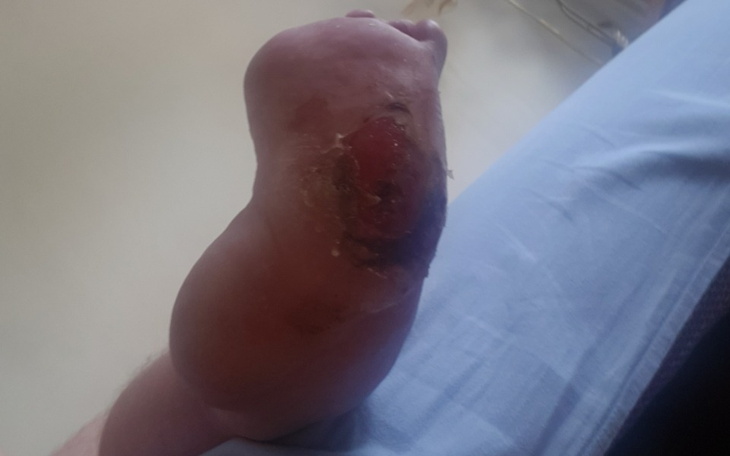 Zbiórka Na Operację Stopy Nogi - zdjęcie główne