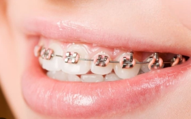 Zbiórka Aparat za zęby, marzenie dziecka - zdjęcie główne