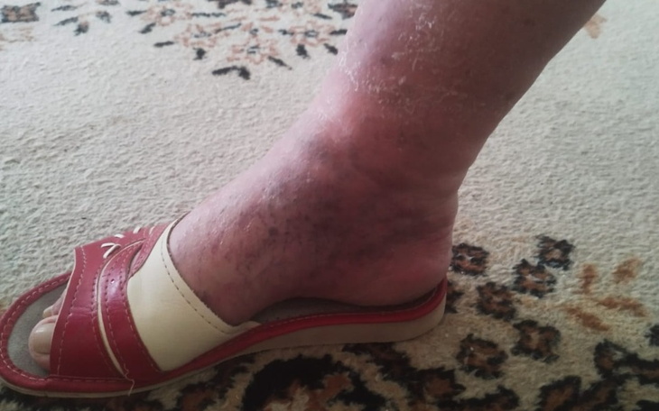 Zbiórka Na operację żylaków. - zdjęcie główne