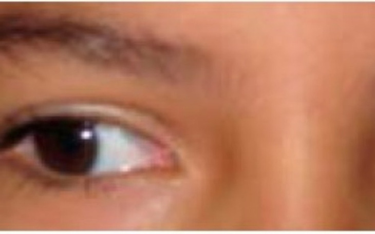 Zbiórka Na operację oczu astygmatyzm zez - zdjęcie główne