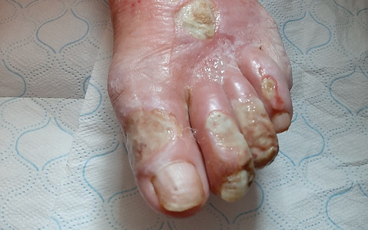 Zbiórka Na ratowanie stóp i nowe życie - zdjęcie główne