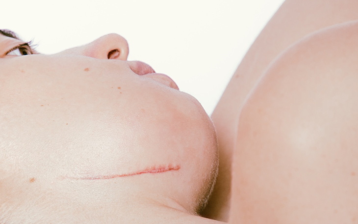 Bliskie ujęcie blizny na szyi osoby.