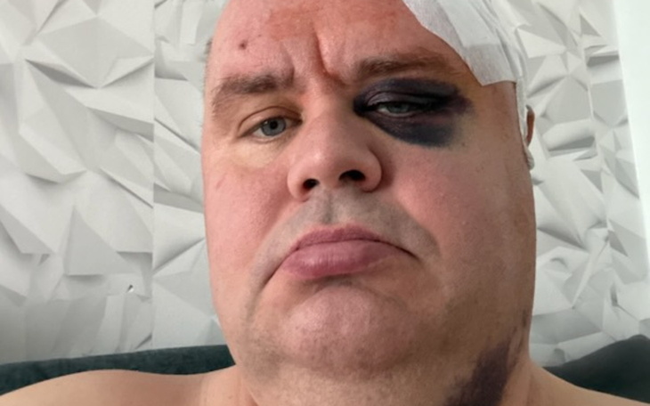 Mężczyzna z siniakiem na twarzy, wygląda na zmartwionego.