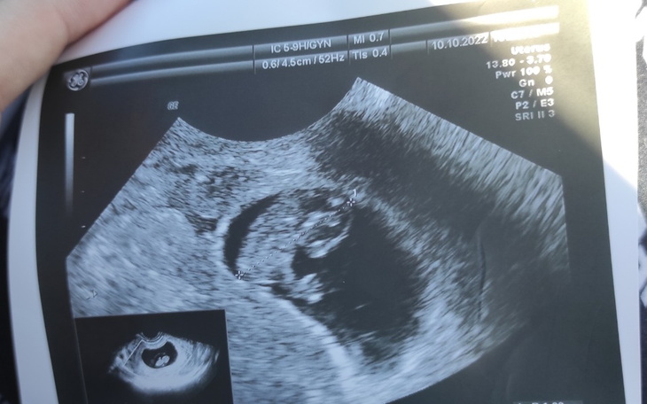 Zbiórka Na badania prenatalne - zdjęcie główne