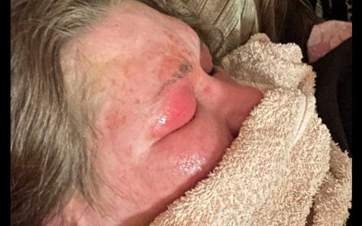 Osoba owinięta ręcznikiem, z podrażnioną skórą na twarzy.