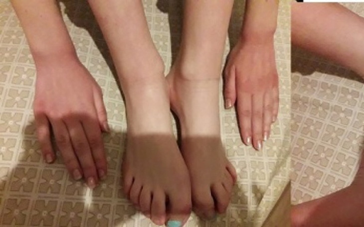 Zbiórka Strzałkowy zanik mięśni - zdjęcie główne