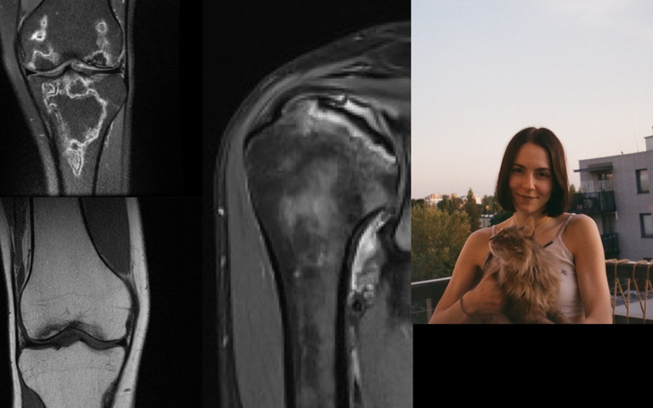 Zdjęcia MRI kolana, pokazujące różne zmiany.