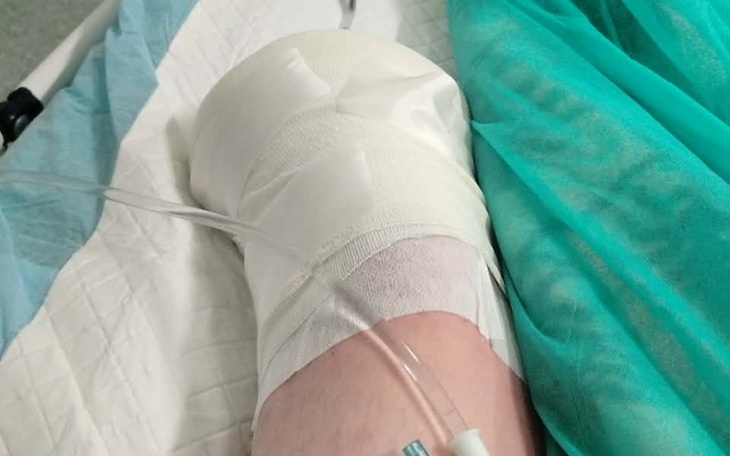 Zabandażowana noga pacjenta w szpitalu.