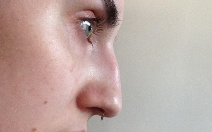 Zbiórka operacja nosa - rinoplastyka - zdjęcie główne