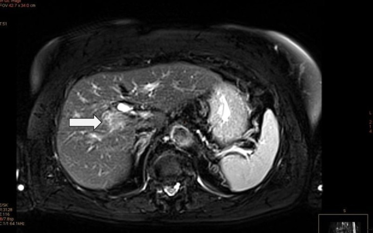 Zbiórka Usunięcie guza Pani Ewelinie z w - zdjęcie główne