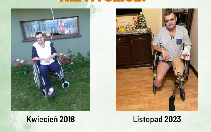Porównanie zdjęć mężczyzny przed i po amputacji nogi.