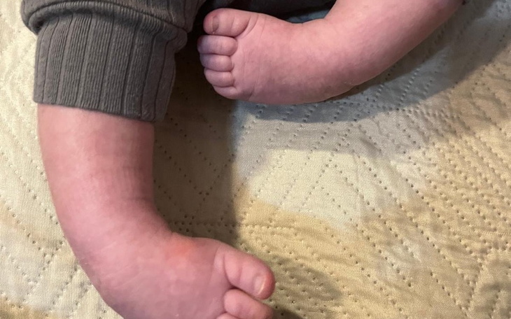 Zbiórka Max Stopa końsko-szpotawa - zdjęcie główne