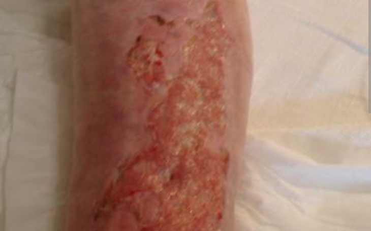 Zbiórka Leczenie poparzenia - zdjęcie główne