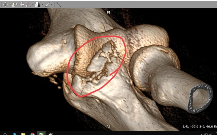 Obraz 3D przedstawiający kontuzjowany staw.