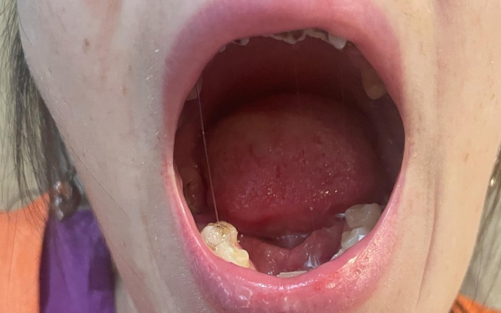 Zbiórka Proteza całej szczęki - zdjęcie główne