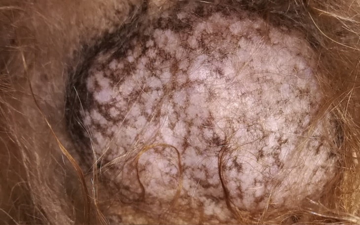 Zbiórka Gruczolak listwy mlecznej - zdjęcie główne