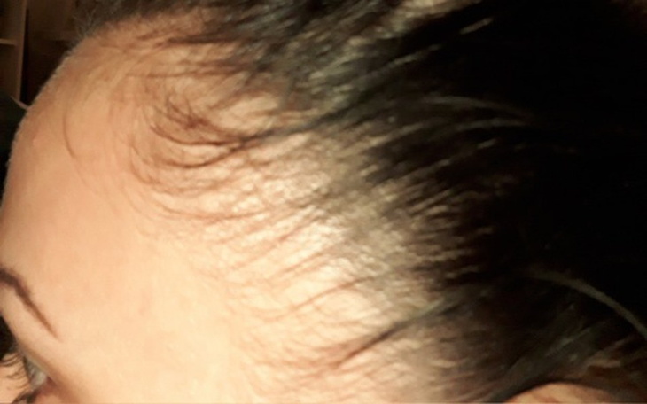 Zbiórka Przeszczep włosów, proszę pomóż - zdjęcie główne