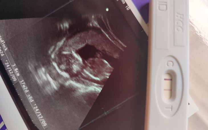 Ultrasonografia pokazująca rozwijający się płód.