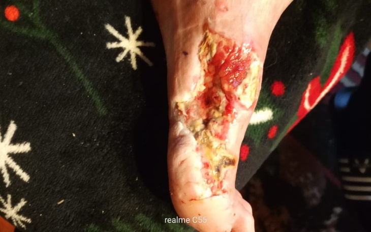 Zraniona stopa z widocznymi obrażeniami.