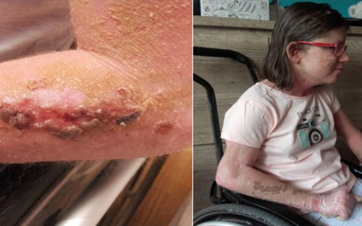 Zbiórka Leczenie i rehabilitacja Julii - zdjęcie główne