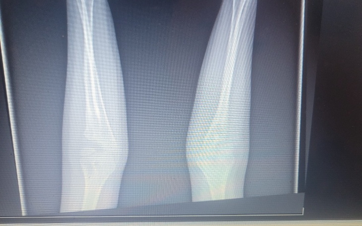 Zbiórka Leczenie syna kościozrost obustr - zdjęcie główne