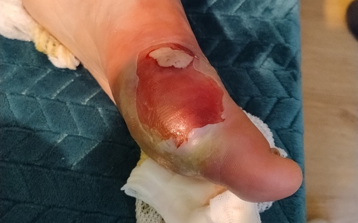 Zbiórka Leczenie Nogi Mojego Brata - zdjęcie główne