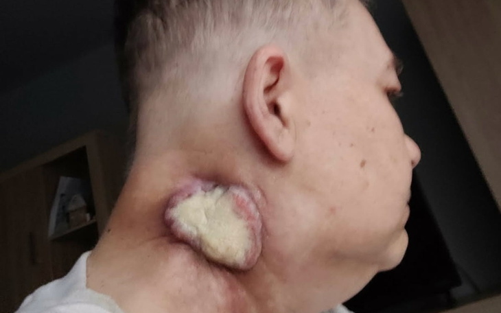 Mężczyzna z raną na szyi.