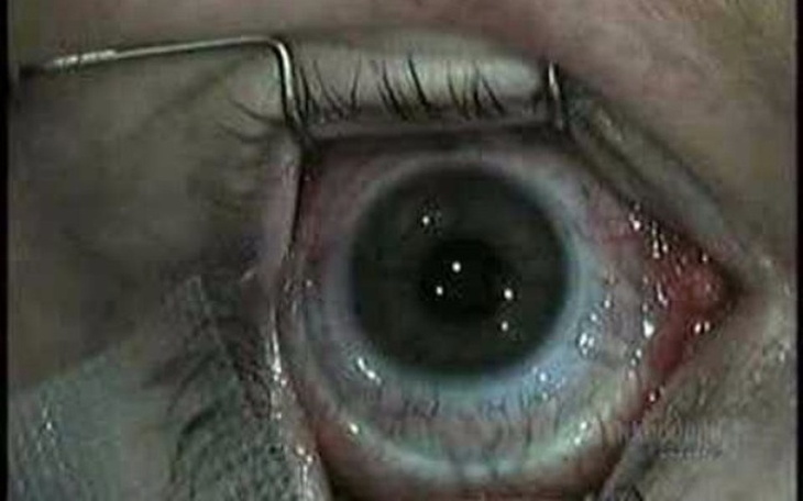 Zbiórka Na operacje oczy - zdjęcie główne