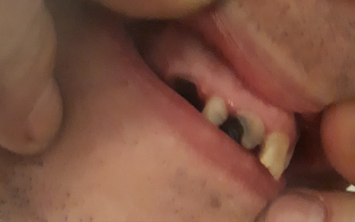 Zbliżenie na uśmiech z brakującymi zębami.