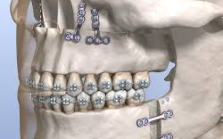 Zbiórka Osteotomia dwuszczękowa BI-MAX - zdjęcie główne