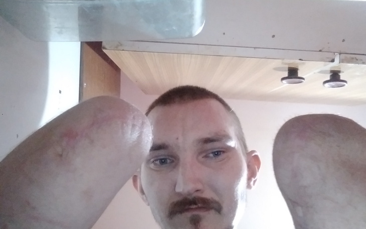 Zbiórka protezy ronk elektryczne - zdjęcie główne