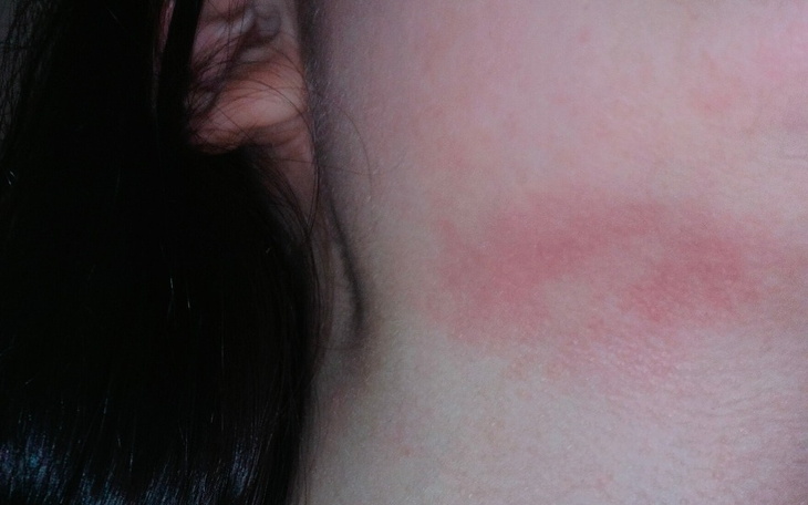 Zbliżenie na skórę z widocznym śladem, prawdopodobnie po podrażnieniu.