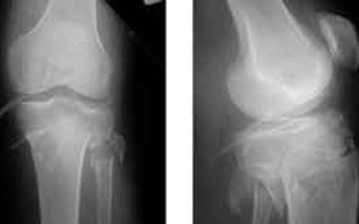 Zdjęcie rentgenowskie kolana, pokazujące kontuzję.