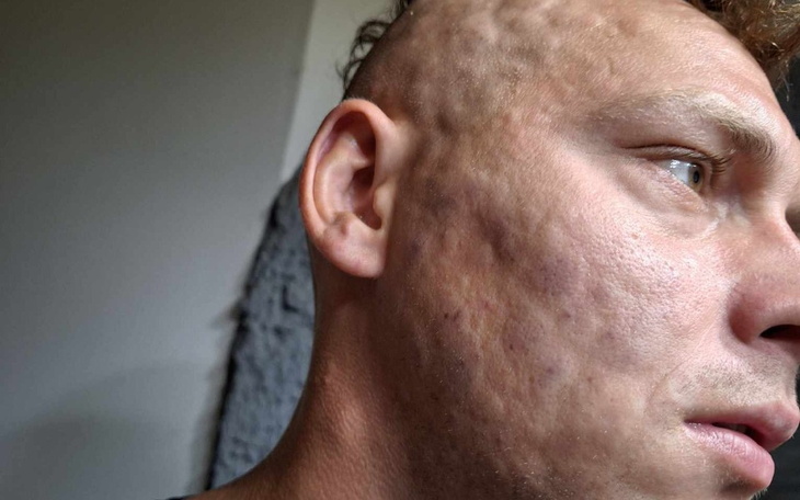 Mężczyzna z bliznami na twarzy, patrzy w bok.