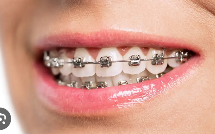 Zbiórka Na aparat na ząbki - zdjęcie główne