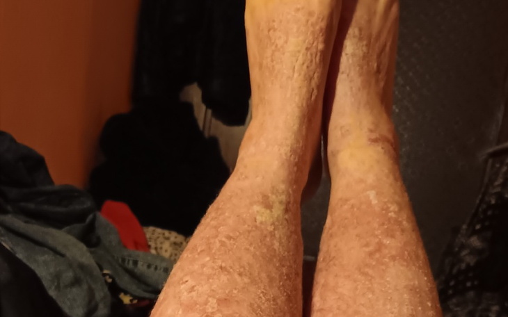 Zbiórka Na leczenie - Łuszczyca - zdjęcie główne