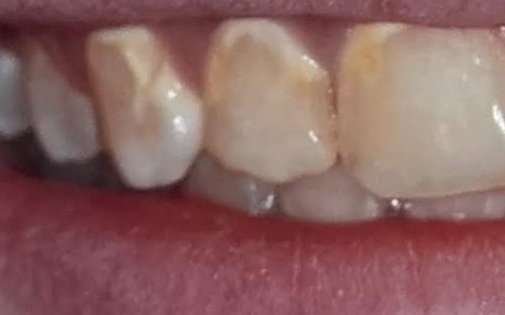 Zbiórka Licówki porcelanowe po aparacie - zdjęcie główne