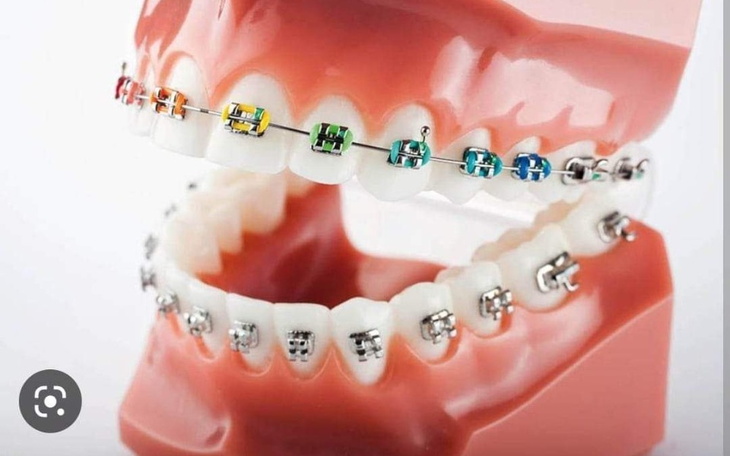 Zbiórka Aparat ortodentyczny.. - zdjęcie główne