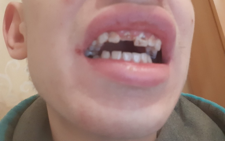 Zbiórka Zbieram na implant jedynki - zdjęcie główne