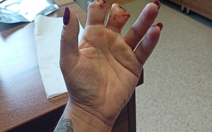 Zbiórka Zbiórka na protezę dla Ani - zdjęcie główne