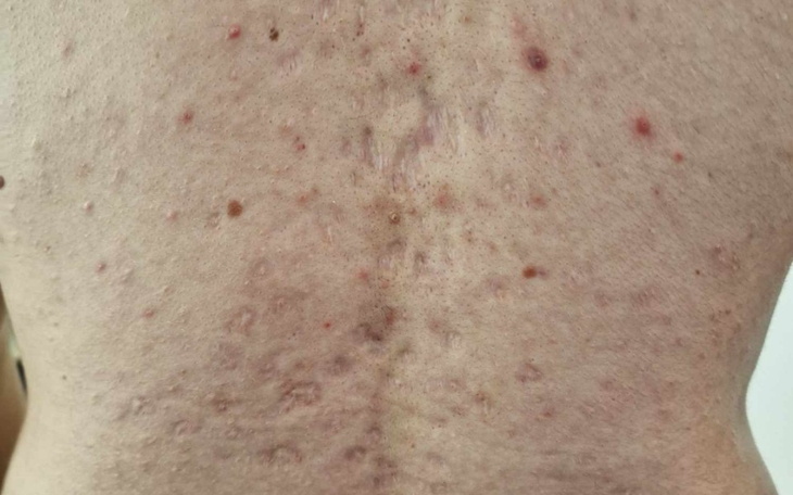 Zbiórka Zabiegi w redukcji blizn - zdjęcie główne