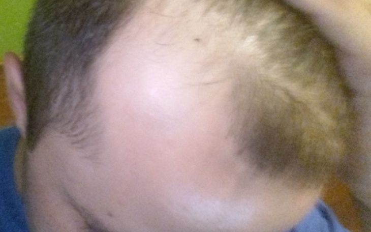 Zbiórka Na przeszczep zakoli - zdjęcie główne