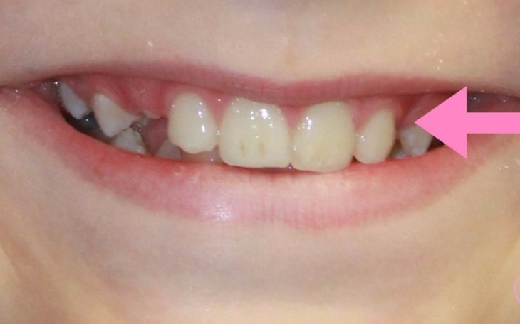 Zbiórka Zbieram na zęby i aparat na zęby - zdjęcie główne