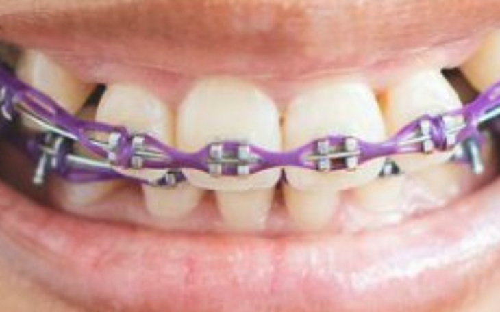 Zbiórka Leczenie i aparat ortodontycznyy - zdjęcie główne