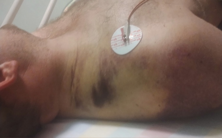 Mężczyzna w szpitalu z elektrodą na ciele.