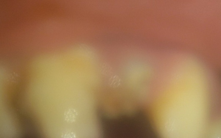 Zbiórka ułamany ząb - zdjęcie główne