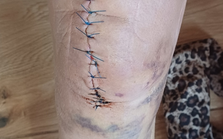 Zblizenie na ranę z szwami na nodze.